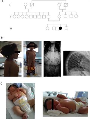 Spondyloocular Syndrome: A Novel XYLT2 Variant with Description of the Neonatal Phenotype